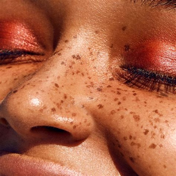 All the Freckles in the World
